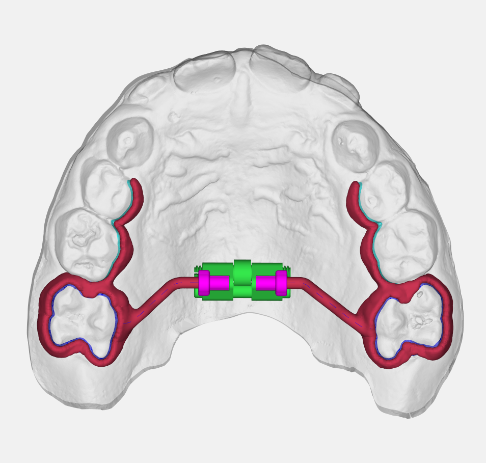Digital design preview of CoCr expander Design 03 on an upper dental model